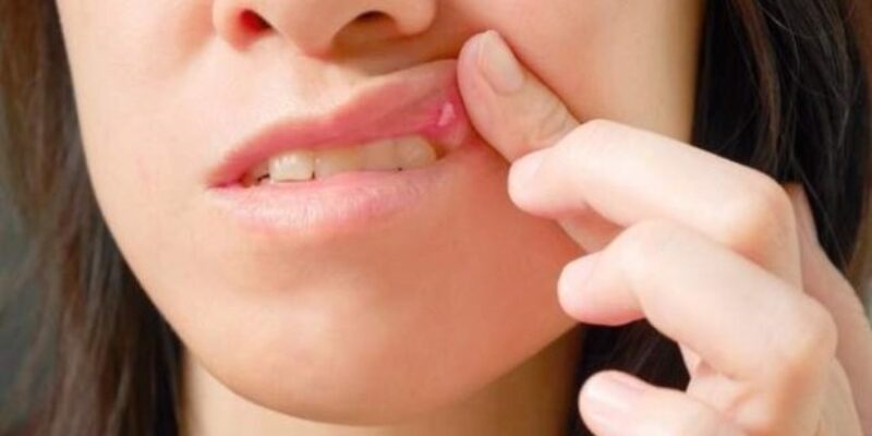 Afte: curarle con i rimedi naturali